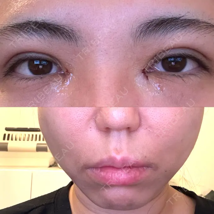 二重埋没 / 目頭切開 / 糸リフト / 鼻翼基部形成（貴族手術） / ヒアルロン酸注入（鼻翼基部） 東京シンデレラ美容外科 池袋院 DAY 0 メイン用