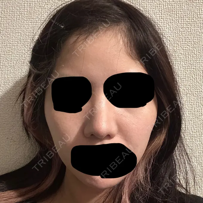 ヒアルロン酸注入（頬） THE FIRST CLINIC 町田院 DAY 13 メイン用