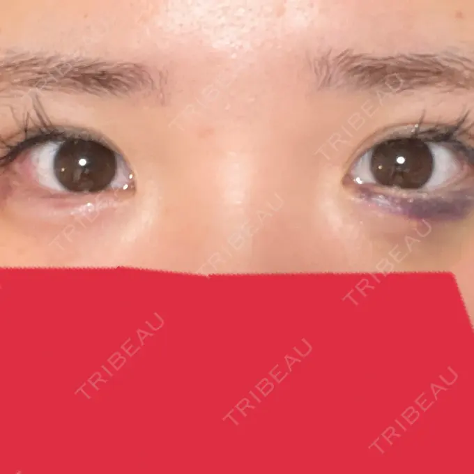 ヒアルロン酸注入（涙袋） アネシス美容クリニック DAY 2 メイン用