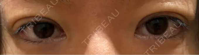 二重埋没 R Beauty CLINIC 銀座院 DAY 0 メイン用