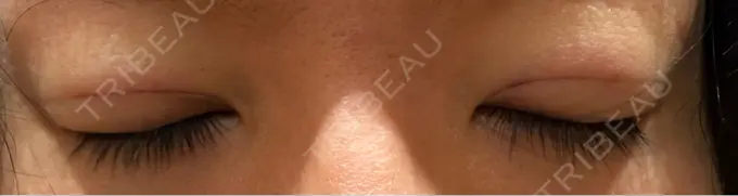 二重埋没 R Beauty CLINIC 銀座院 DAY 0 メイン用