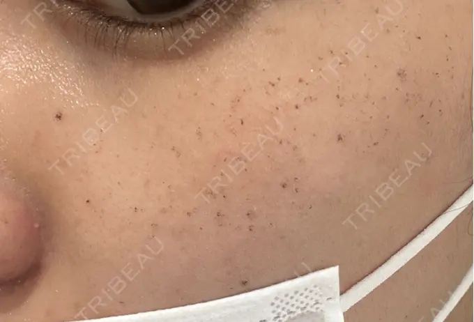 その他（肌） / イオン導入 / ルメッカ ルラ美容クリニック 広島院 DAY 2 メイン用