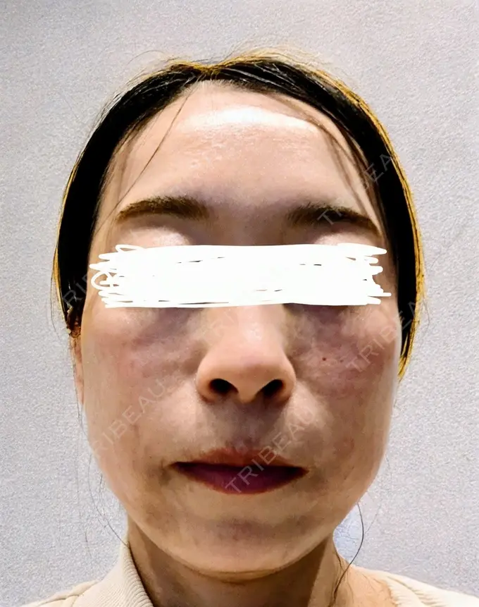 肌育注射（ジュベルックなど） / リジュラン 城本クリニック 横浜院 DAY 0 メイン用