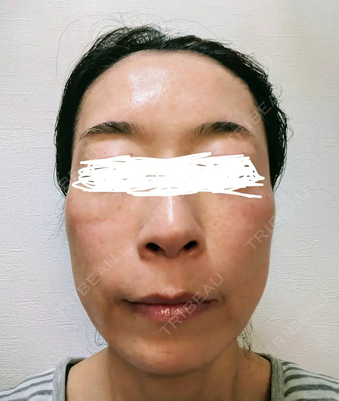 肌育注射（ジュベルックなど） / リジュラン 城本クリニック 横浜院 DAY 1 メイン用