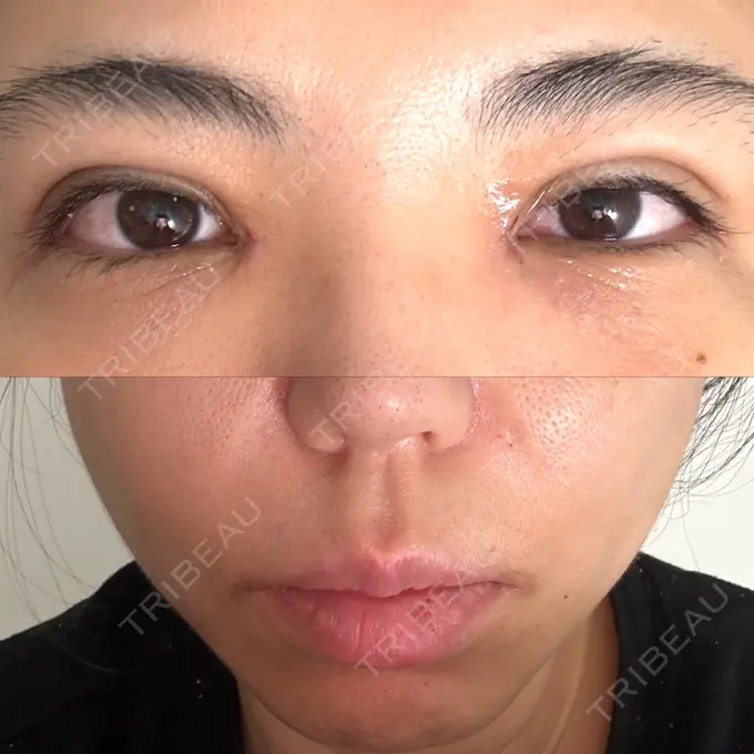 二重埋没 / 目頭切開 / 糸リフト / 鼻翼基部形成（貴族手術） / ヒアルロン酸注入（鼻翼基部） 東京シンデレラ美容外科 池袋院 DAY 1 メイン用