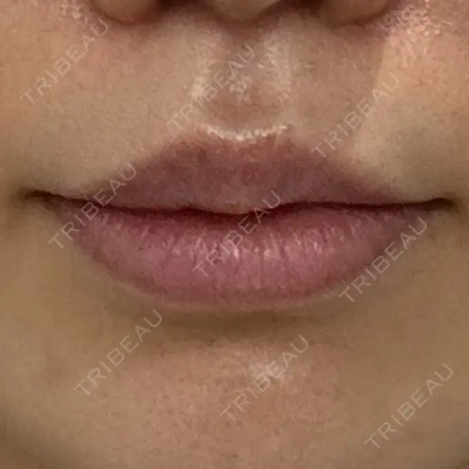 人中短縮 eクリニック 大阪梅田 西日本統括院 DAY 74 メイン用