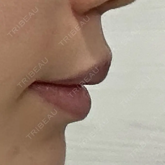 人中短縮 eクリニック 大阪梅田 西日本統括院 DAY 74 メイン用