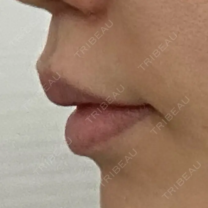 人中短縮 eクリニック 大阪梅田 西日本統括院 DAY 74 メイン用