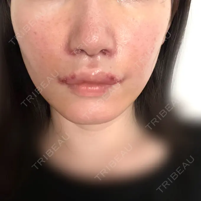 小鼻縮小（切開） / 人中短縮 / 鼻孔縁挙上 / 口角挙上 / ボトックス（口角） / ボトックス（人中） Otus Clinic 【オータスクリニック】 DAY 8 メイン用