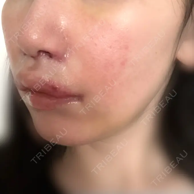 小鼻縮小（切開） / 人中短縮 / 鼻孔縁挙上 / 口角挙上 / ボトックス（口角） / ボトックス（人中） Otus Clinic 【オータスクリニック】 DAY 8 メイン用