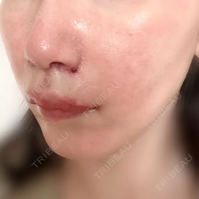 小鼻縮小（切開） / 人中短縮 / 鼻孔縁挙上 / 口角挙上 / ボトックス（口角） / ボトックス（人中） Otus Clinic 【オータスクリニック】 DAY 18 メイン用