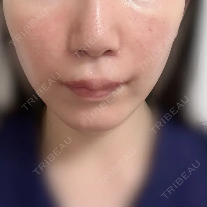 小鼻縮小（切開） / 人中短縮 / 鼻孔縁挙上 / 口角挙上 / ボトックス（口角） / ボトックス（人中） Otus Clinic 【オータスクリニック】 DAY 35 メイン用