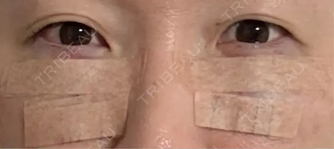 クマ治療 eクリニック 横浜みなとみらい院 DAY 0 メイン用