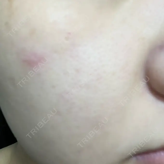 毛穴洗浄（ハイドラフェイシャルなど） 心斎橋KT美容クリニック AFTER メイン用