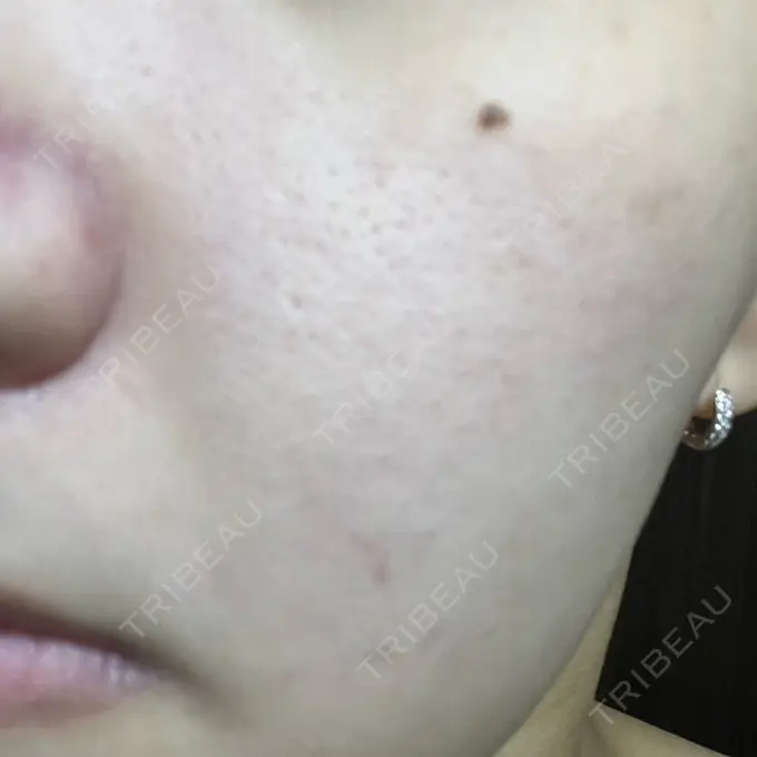 毛穴洗浄（ハイドラフェイシャルなど） 心斎橋KT美容クリニック DAY 1 メイン用