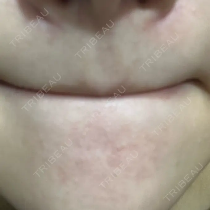 毛穴洗浄（ハイドラフェイシャルなど） 心斎橋KT美容クリニック DAY 1 メイン用