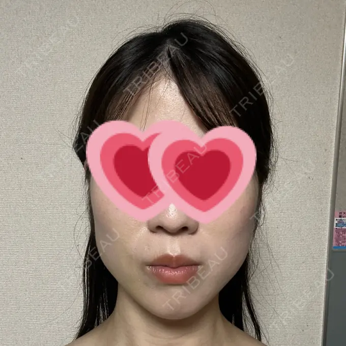 糸リフト / ボトックス（エラ・小顔） アリエル美容クリニック 横浜院 DAY 7 メイン用