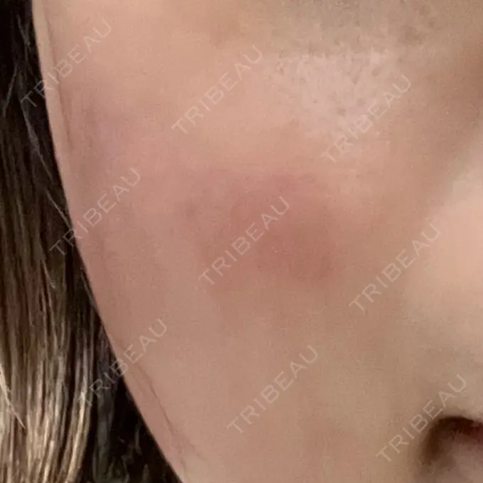 RF（高周波）たるみ治療 豊洲内科・糖尿病 / 形成・美容外科クリニック DAY 1 メイン用