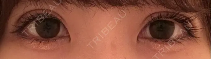 二重埋没 アリエル美容クリニック 水戸院 DAY 25 メイン用