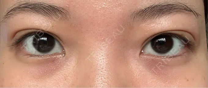 二重埋没 Brandnew Beauty Clinic AFTER メイン用