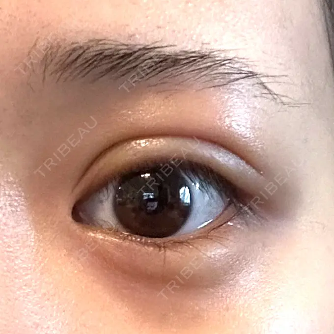 二重埋没 / ヒアルロン酸注入（涙袋） / ヒアルロン酸注入（唇） / その他（口元） 恵聖会クリニック 京橋院 DAY 2 メイン用