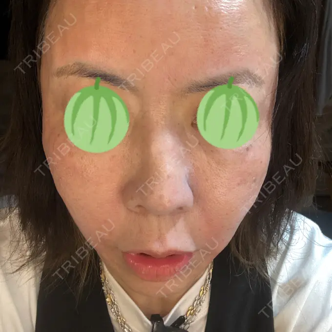 ポテンツァ ルラ美容クリニック 大宮院 / ルラスキンクリニック 大宮院 DAY 1 メイン用