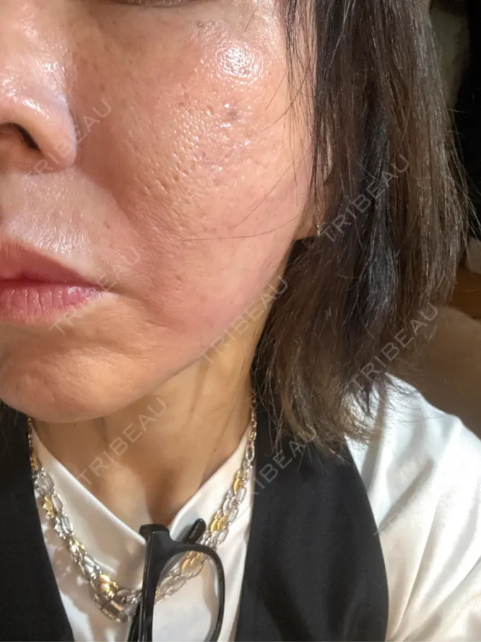 ポテンツァ ルラ美容クリニック 大宮院 / ルラスキンクリニック 大宮院 DAY 1 メイン用