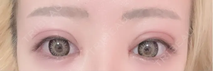 二重埋没 / 目頭切開 eクリニック 福岡院 AFTER メイン用