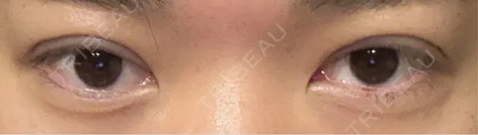 二重埋没 水の森美容クリニック 東京新宿院 DAY 1 メイン用