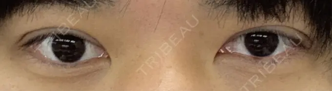 二重埋没 水の森美容クリニック 東京新宿院 DAY 2 メイン用