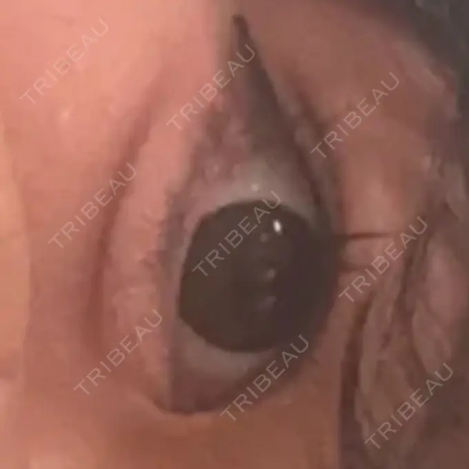 ヒアルロン酸注入（涙袋） / ヒアルロン酸注入（唇） アリエル美容クリニック 横浜院 DAY 1 メイン用