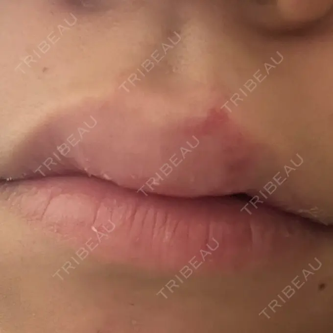 ヒアルロン酸注入（涙袋） / ヒアルロン酸注入（唇） アリエル美容クリニック 横浜院 DAY 1 メイン用