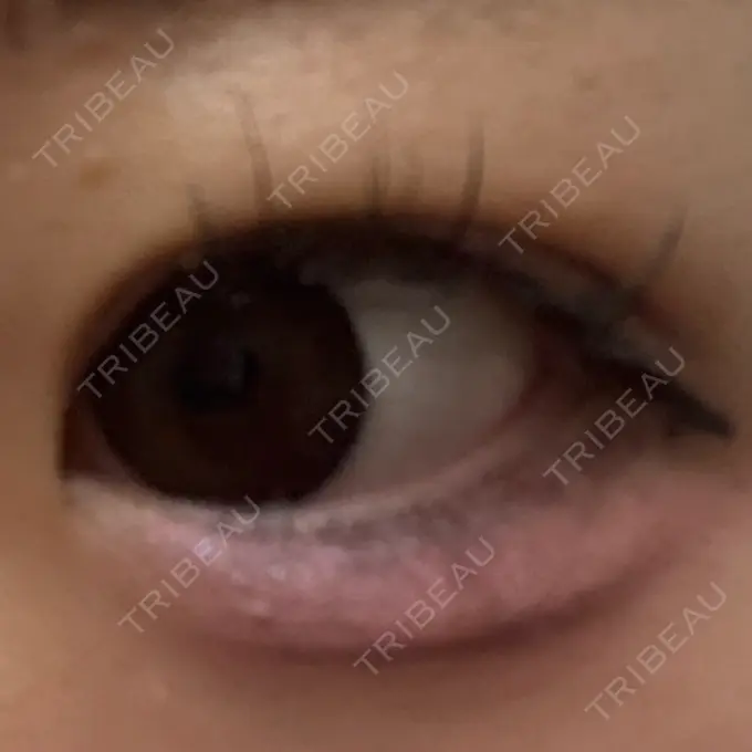 ヒアルロン酸注入（涙袋） / ヒアルロン酸注入（唇） アリエル美容クリニック 横浜院 DAY 3 メイン用