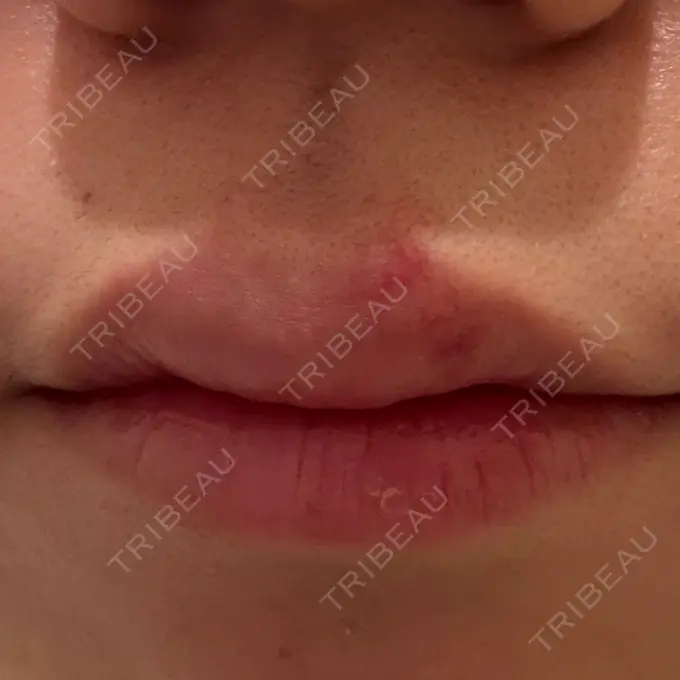 ヒアルロン酸注入（涙袋） / ヒアルロン酸注入（唇） アリエル美容クリニック 横浜院 DAY 4 メイン用