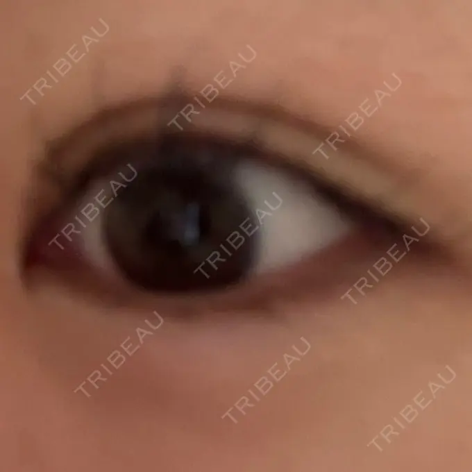 ヒアルロン酸注入（涙袋） / ヒアルロン酸注入（唇） アリエル美容クリニック 横浜院 DAY 5 メイン用