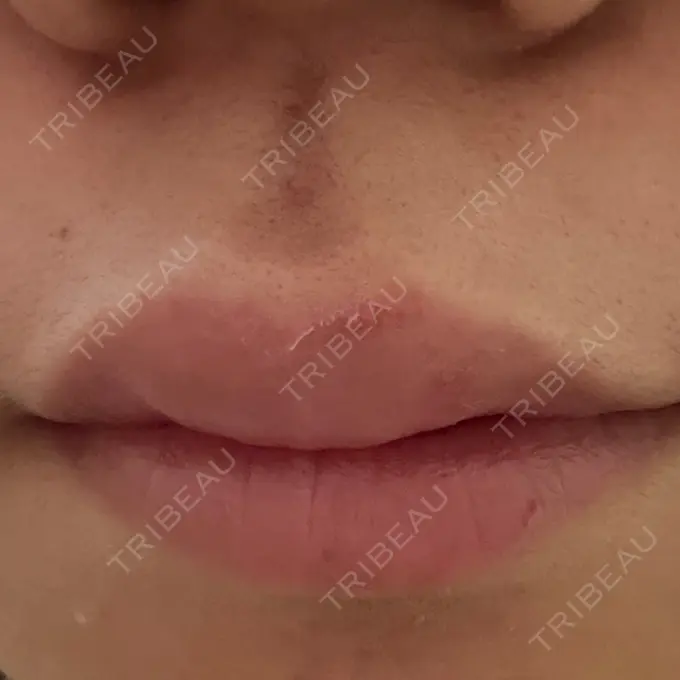 ヒアルロン酸注入（涙袋） / ヒアルロン酸注入（唇） アリエル美容クリニック 横浜院 DAY 5 メイン用