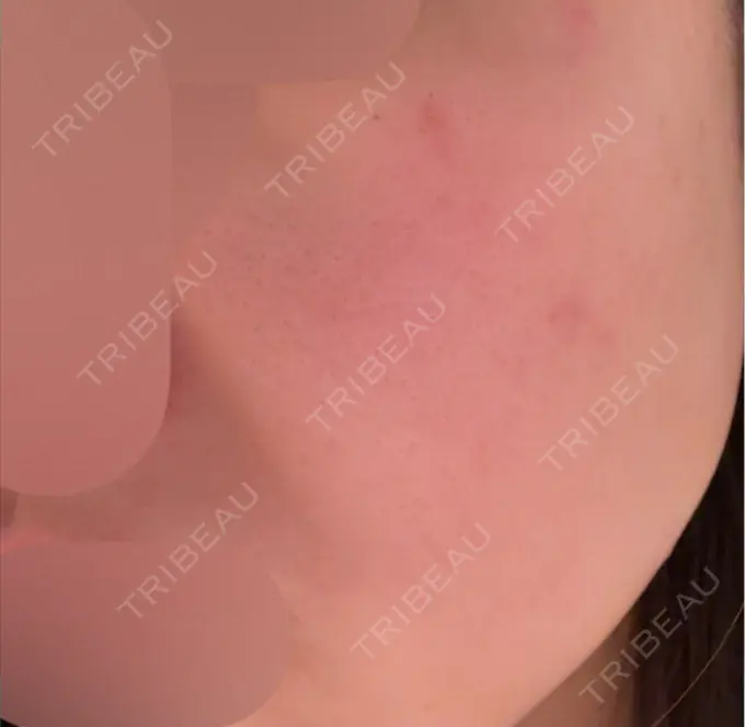 エレクトロポレーション / 毛穴洗浄（ハイドラフェイシャルなど） / 医療脱毛（顔） さっぽろ美容クリニック DAY 0 メイン用