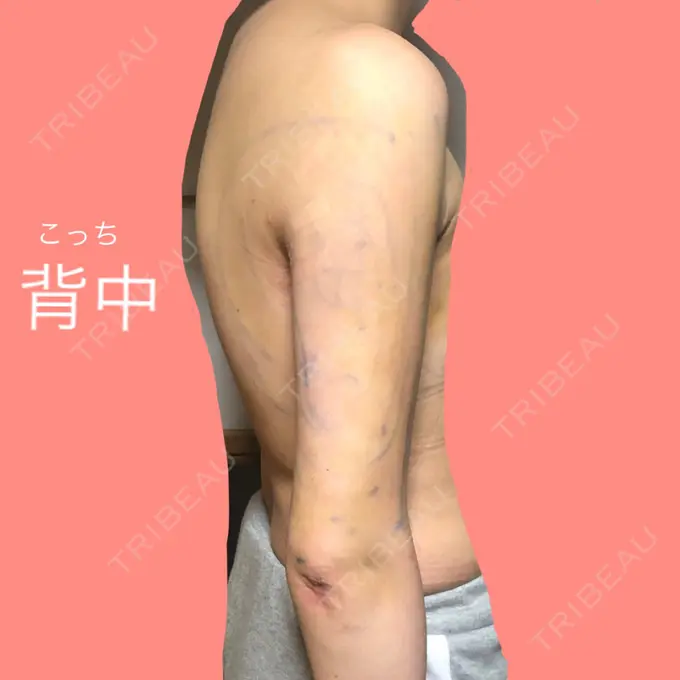 脂肪吸引（二の腕） ヨンセスリムライン DAY 5 メイン用