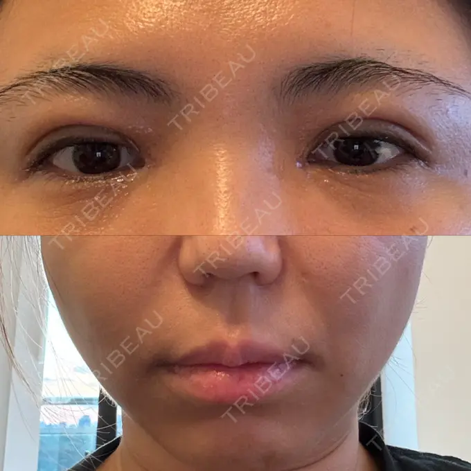 二重埋没 / 目頭切開 / 糸リフト / 鼻翼基部形成（貴族手術） / ヒアルロン酸注入（鼻翼基部） 東京シンデレラ美容外科 池袋院 DAY 2 メイン用