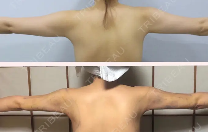 脂肪吸引（二の腕） ヨンセスリムライン DAY 5 メイン用