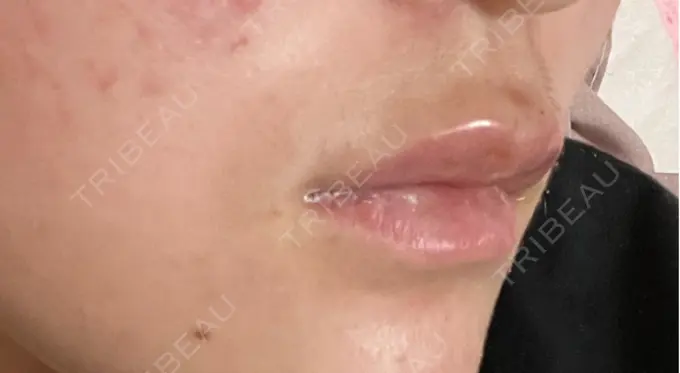 ボトックス（エラ・小顔） / ヒアルロン酸注入（唇） / ボトックス（口角） フィラークリニック 名古屋栄院 AFTER メイン用