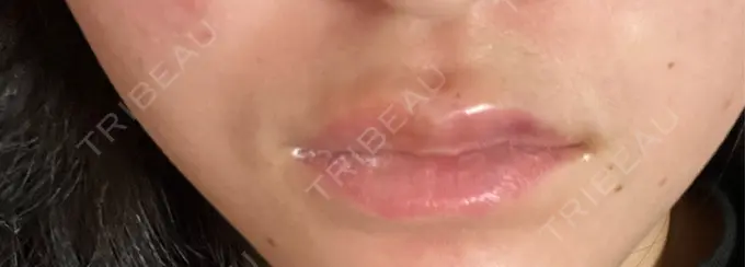 ボトックス（エラ・小顔） / ヒアルロン酸注入（唇） / ボトックス（口角） フィラークリニック 名古屋栄院 DAY 0 メイン用