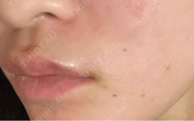 ボトックス（エラ・小顔） / ヒアルロン酸注入（唇） / ボトックス（口角） フィラークリニック 名古屋栄院 DAY 0 メイン用