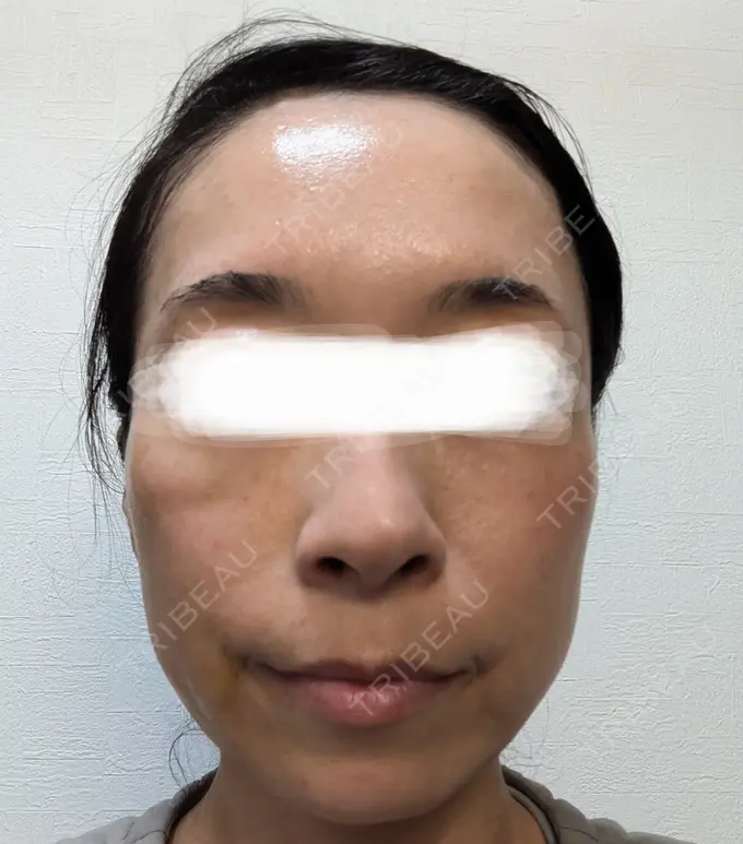 肌育注射（ジュベルックなど） / リジュラン 城本クリニック 横浜院 DAY 3 メイン用