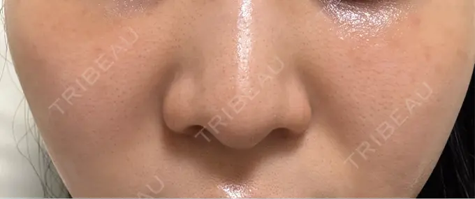 肌育注射（ジュベルックなど） 城本クリニック 名古屋院 DAY 7 メイン用