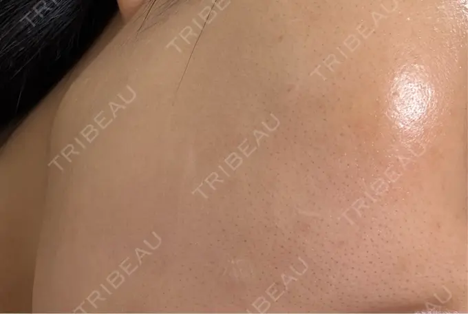 肌育注射（ジュベルックなど） 城本クリニック 名古屋院 DAY 7 メイン用