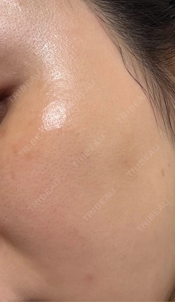 肌育注射（ジュベルックなど） 城本クリニック 名古屋院 DAY 7 メイン用