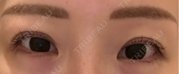 二重埋没 宇都宮竹内クリニック AFTER メイン用