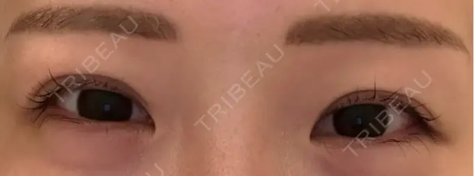 二重埋没 宇都宮竹内クリニック DAY 18 メイン用