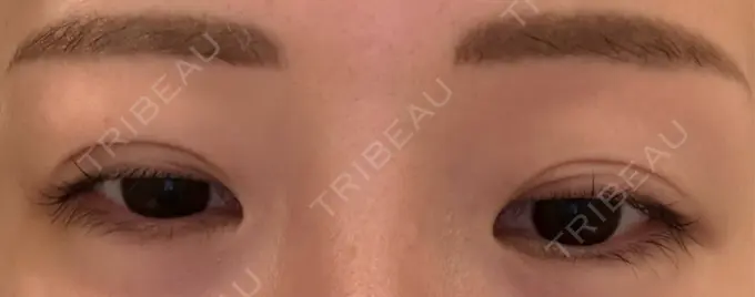 二重埋没 宇都宮竹内クリニック DAY 18 メイン用